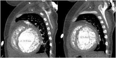 1p36 Deletion Syndrome and Left Ventricular Non-compaction Cardiomyopathy—Two Cases Report